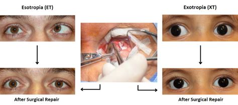strabismus surgery near el cerrito  One eye may look straight ahead while the other eye turns in, out, up, or down